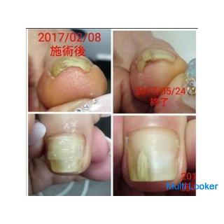 Korrektur eingewachsener Nägel