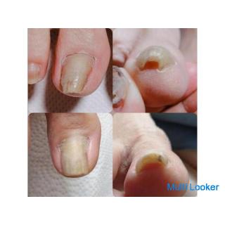 Ingrown nail correction